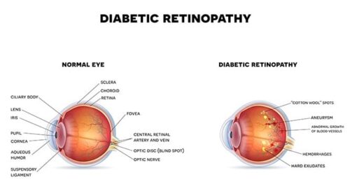 on4-diabetic-retinopathy2